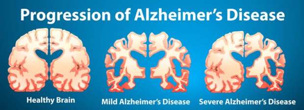 alz report